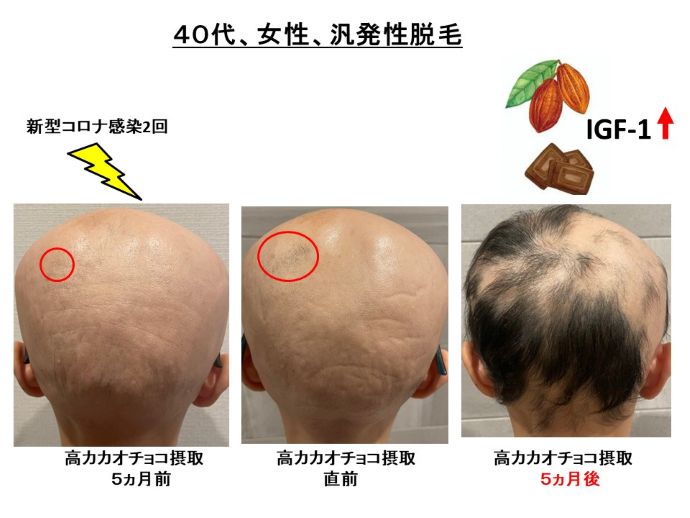 円形脱毛症　病院